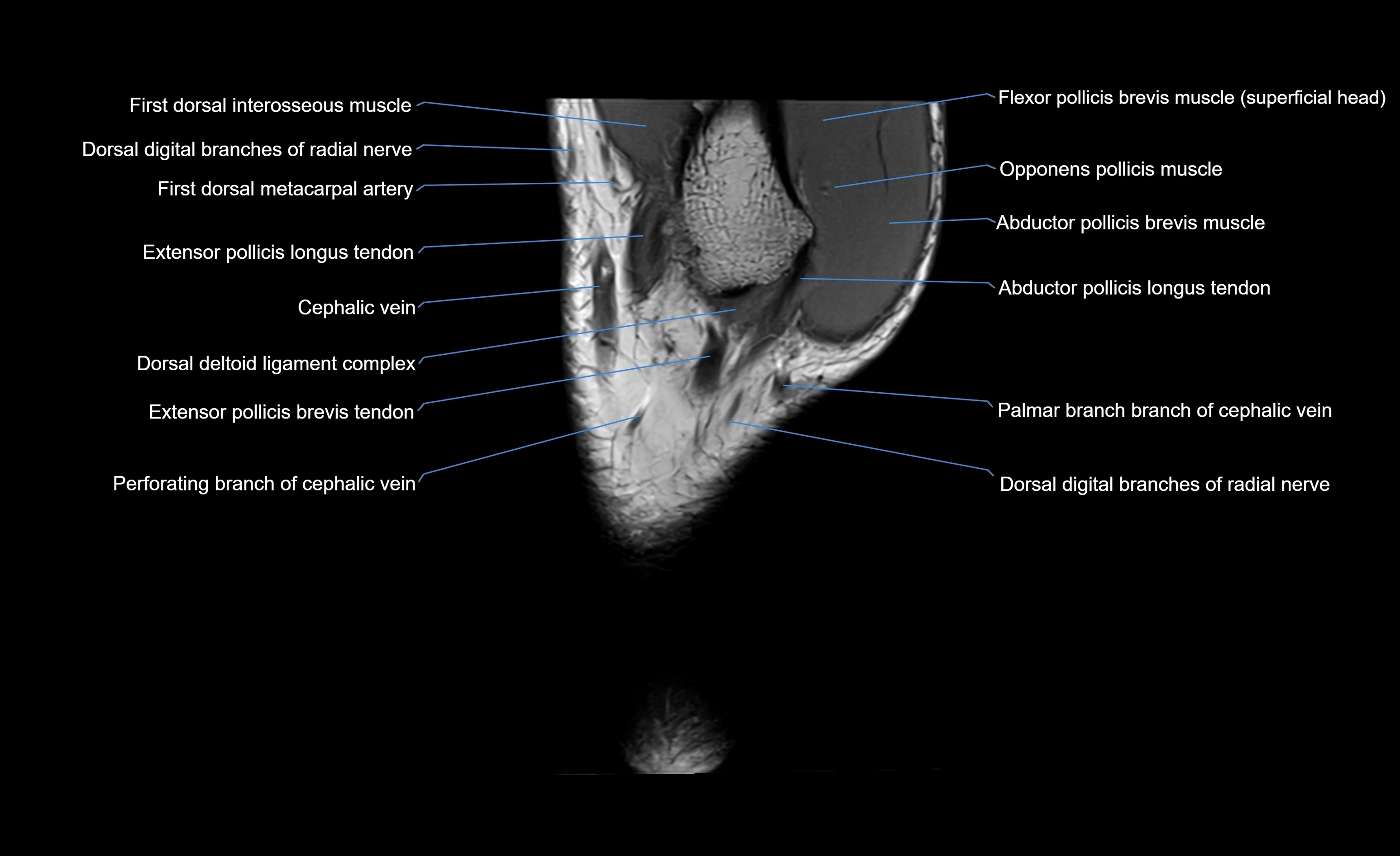 MRI wrist sagittal cross sectional anatomy 3T  radiology  image-img-00001-00001.webp